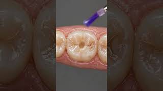 Fixing a Small Tooth Cavity 🦷 3D Dental Animation