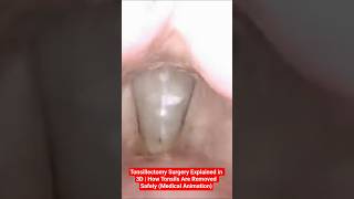 Tonsillectomy Surgery Explained in 3D | How Tonsils Are Removed Safely (Medical Animation)