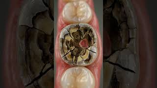 What Happens If You Delay Dental Treatment 🦷 3D Dental Animation #satisfying