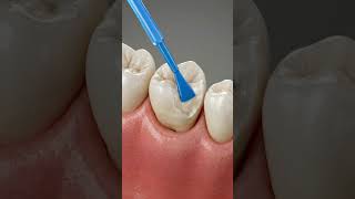 Tooth Structure Repaired 🦷 Composite Fill 3D Animation