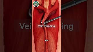 What Happens When Your Heart Valve Fails (Inside Your Body)